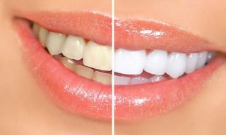 blanqueamientos dentales en san juan Smile Dental Wellness - Inés M. Acarón, Dentista